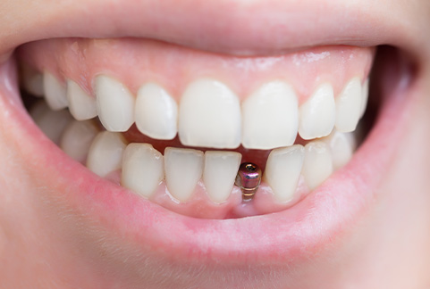 Close up of mouth with unrestored dental implant