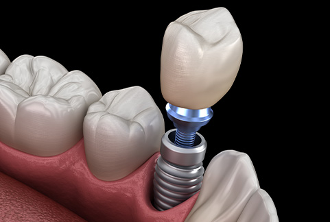 Illustration of crown being attached to dental implant