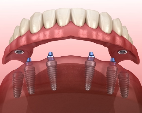 Animated smile showing dental implant denture placement process