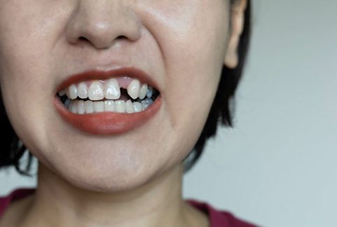 Woman smiling to reveal a missing tooth